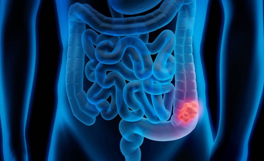 CÁNCER COLON RECTAL
